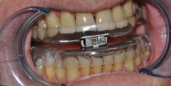 sleep apnea device shown on teeth