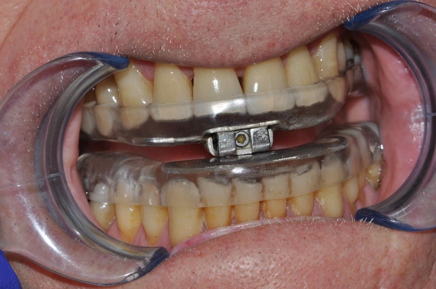sleep apnea device shown on teeth