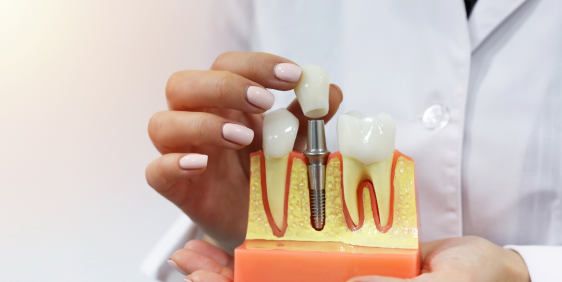 Dental crowns Health Hub Fortitude Valley