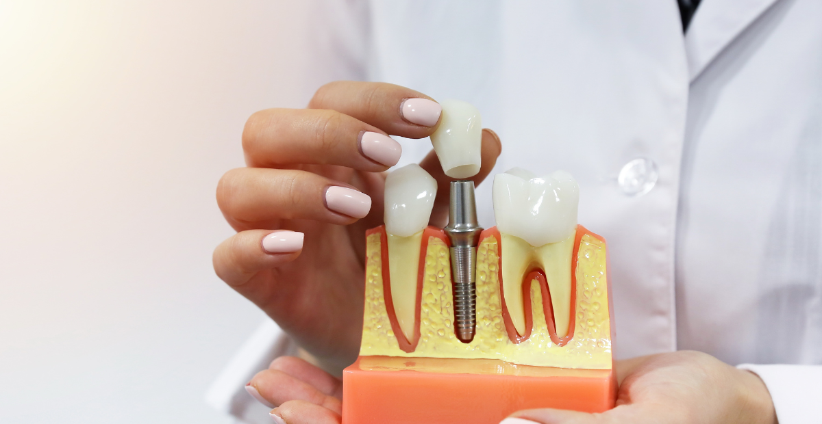 Dental crowns Health Hub Fortitude Valley