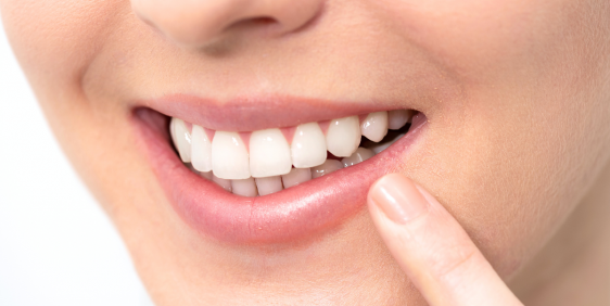 Teeth whitening Health Hub Fortitude Valley