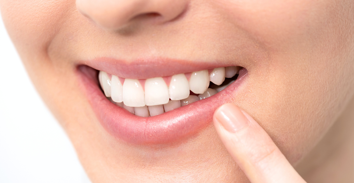 Teeth whitening Health Hub Fortitude Valley